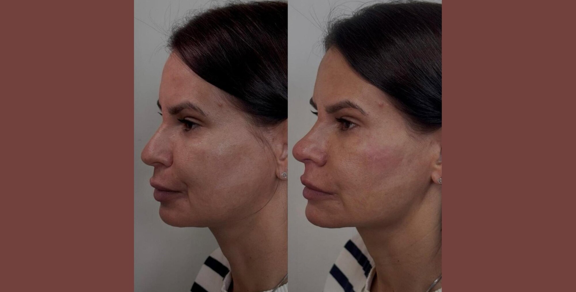 Antes e depois · Harmonização de perfil
