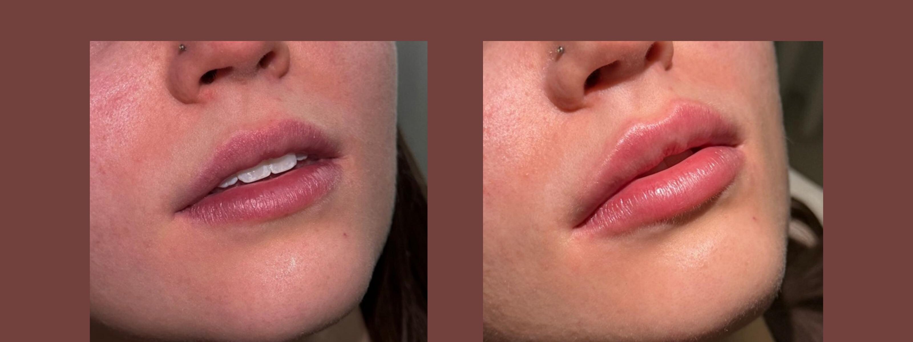 Antes e depois · Preenchimento labial